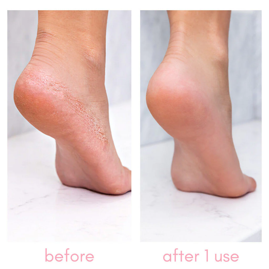 Heel-ing Callus Remover - Image 2