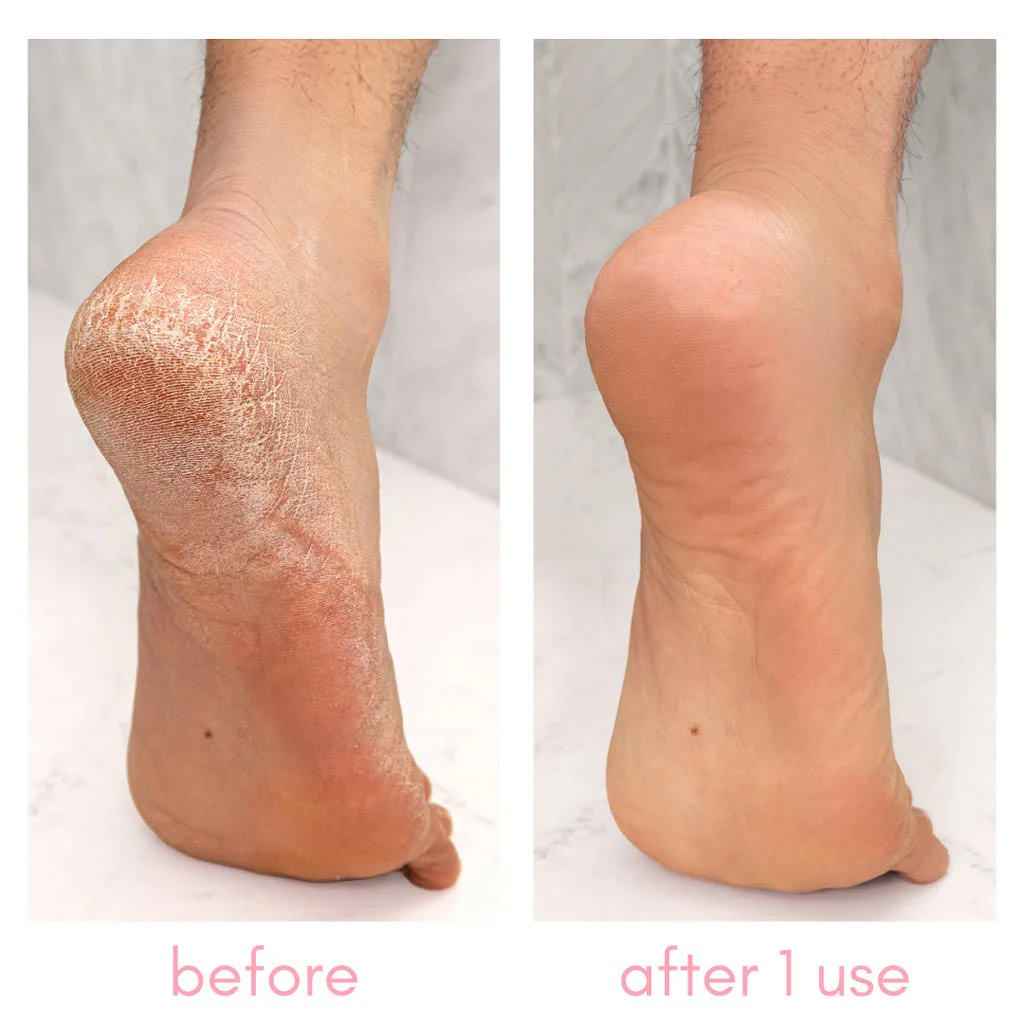 Heel-ing Callus Remover - Image 4